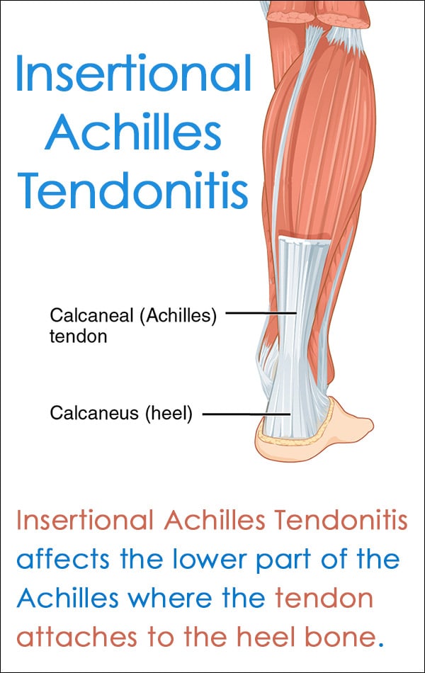 Achilles Tendonitis — Amy Richardson, DPM - Redmond Foot & Ankle -  Podiatrist