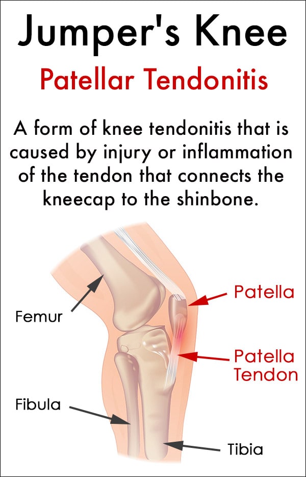 Jumper's Knee Symptoms and Treatment (Patellar Tendonitis) – Medical Wave